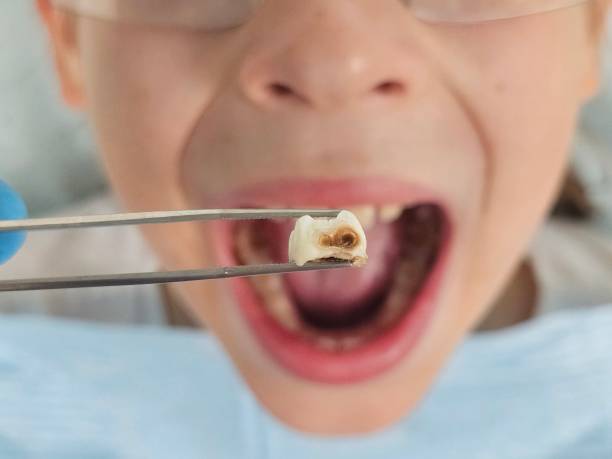 Best Emergency Dental Extractions in Broadlands, VA